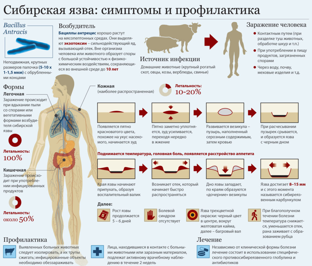 Сибирская язва - Признаки и симптомы